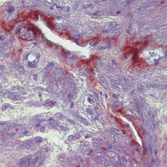 MMP9 in prostate cancer